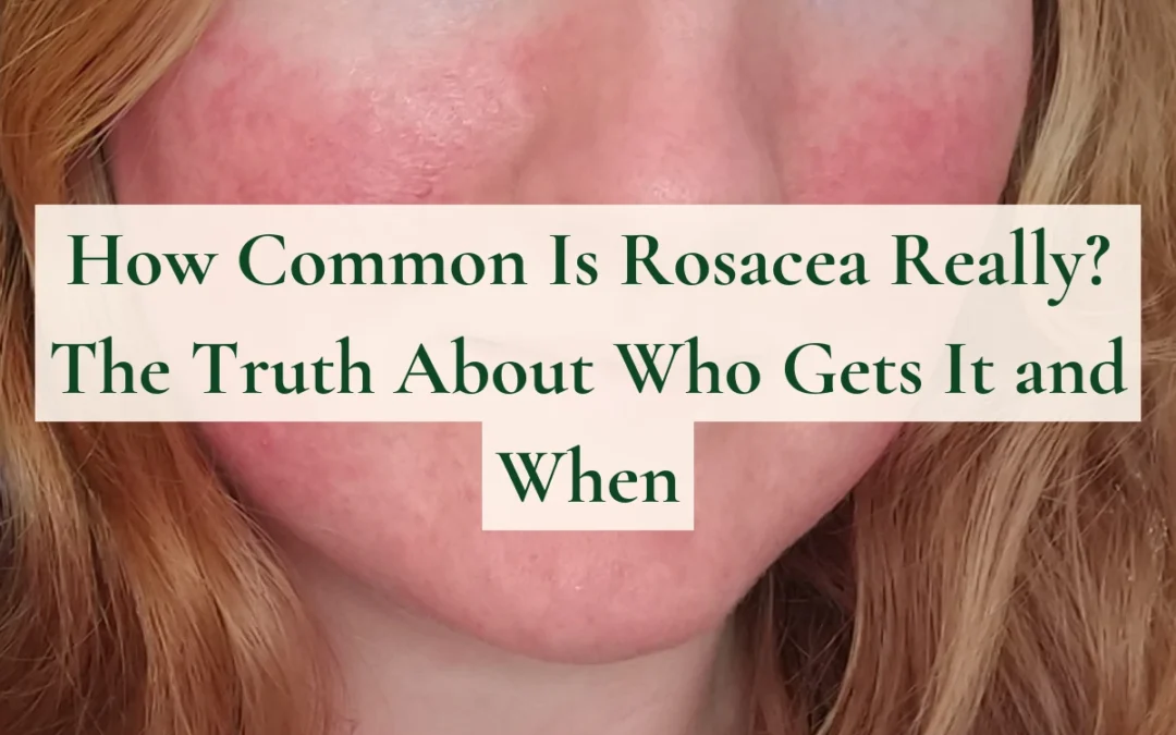 How Common Is Rosacea Really? The Truth About Who Gets It and When