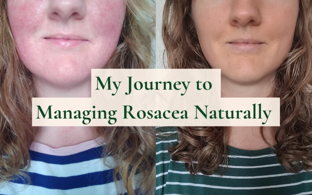 My Journey to Managing Rosacea Naturally