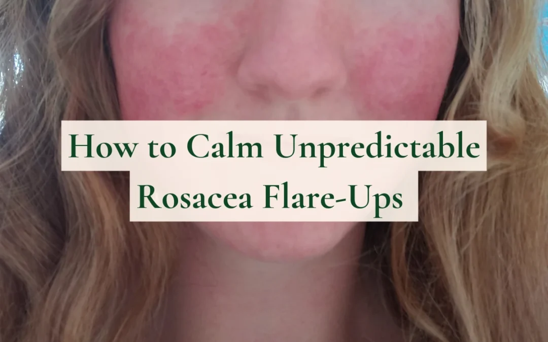 How to Calm Unpredictable Rosacea Flare-Ups (6 Natural Tips)