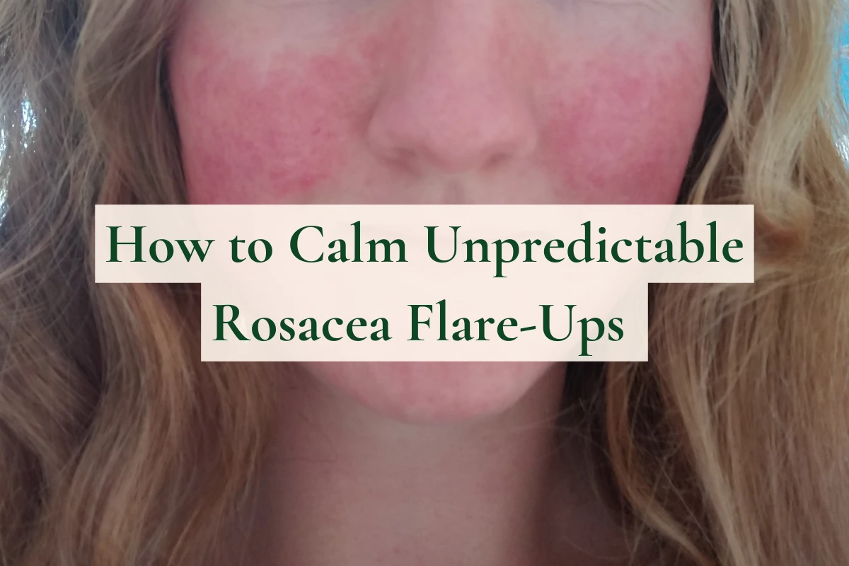 Close-up of a woman’s cheeks with visible rosacea redness during a flare-up