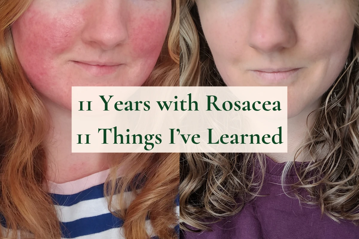 11 Years with Rosacea Close-up of lower face showing rosacea redness on left and improved skin on right; overlay text reads "11 Years with Rosacea"